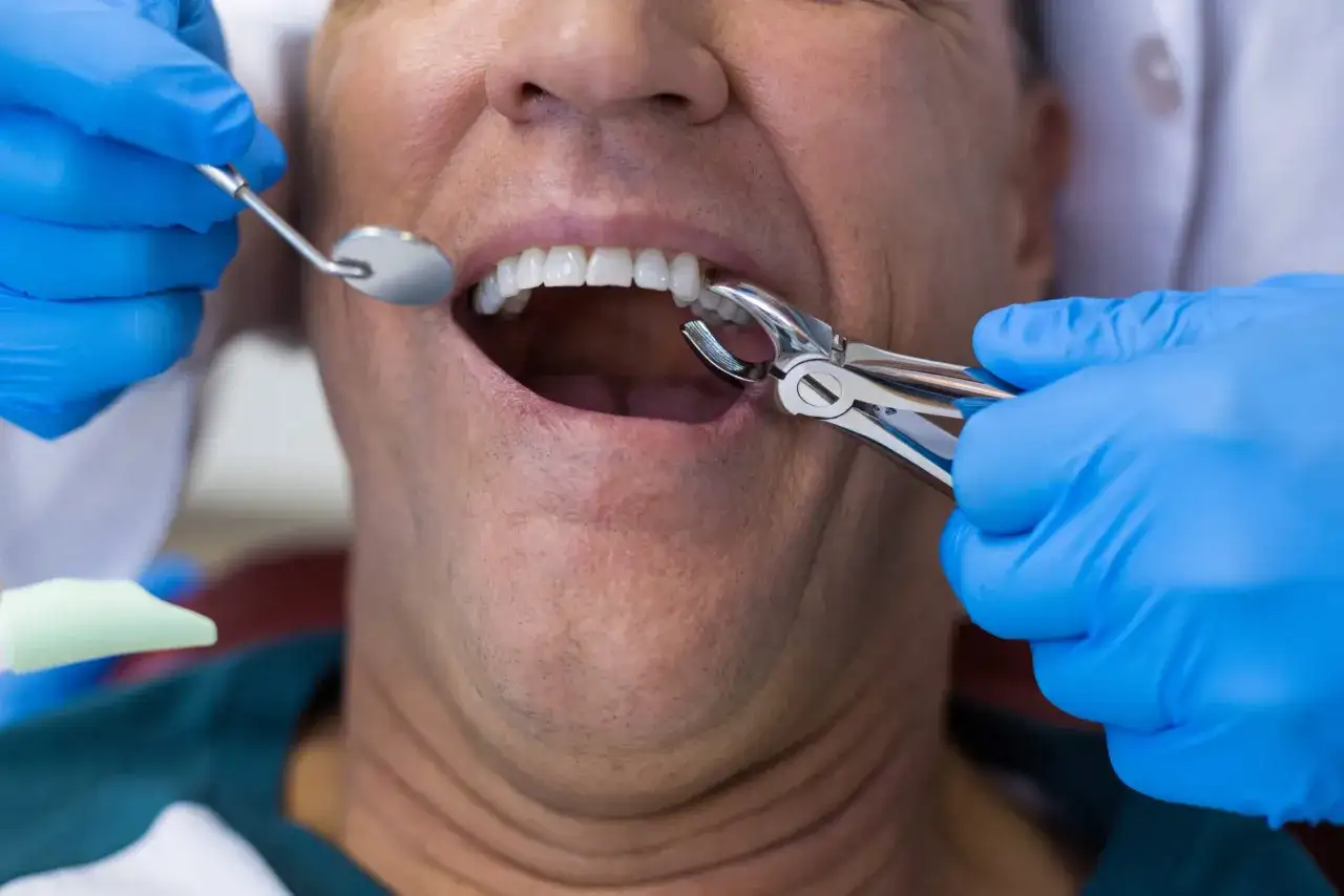 Ból po wyrwaniu zęba - co jest normą, a kiedy do dentysty?