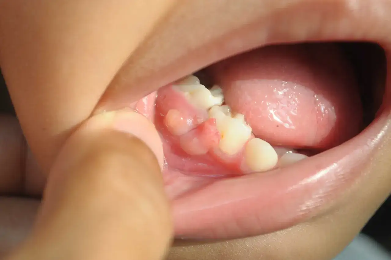 Bolesna kulka na dziąśle - co oznacza i kiedy do dentysty?