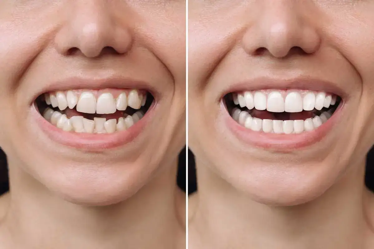 Przed i po: krzywe zęby wyprostowane dzięki aparatowi Invisalign. Niesamowite efekty!