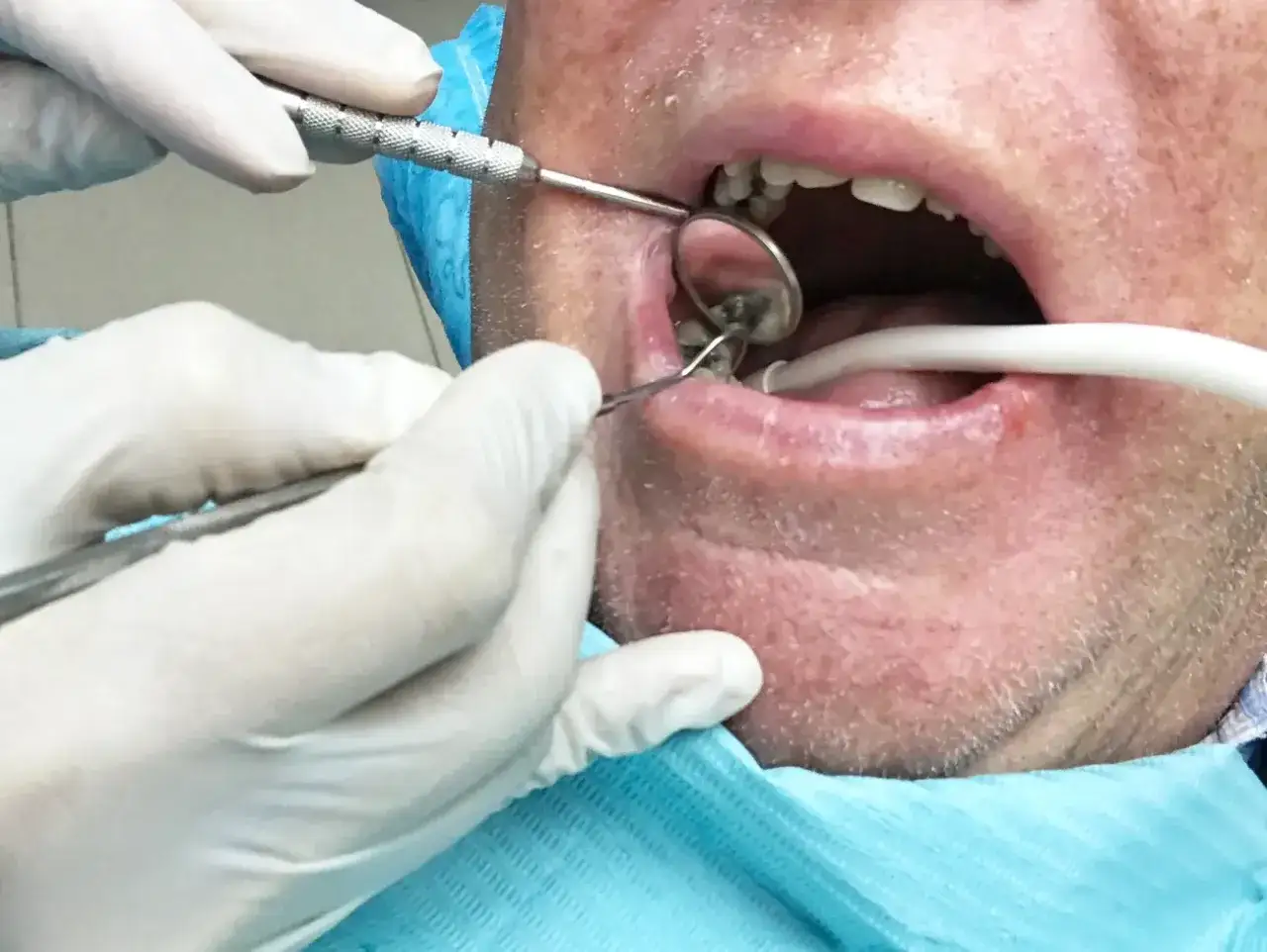 Dentysta wykonuje ekstrakcję zęba przy stanie zapalnym, używając lusterka i narzędzi.