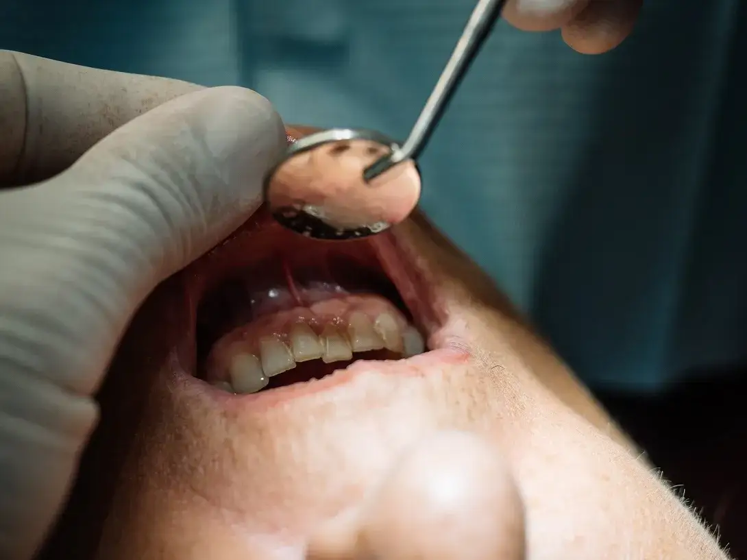Zdjęcie Uczulenie na znieczulenie u dentysty objawy, które mogą zaskoczyć