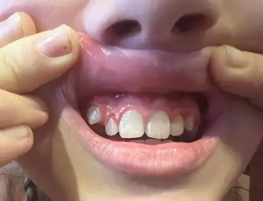 Ząb wyrasta bokiem z dziąsła? Co to znaczy i kiedy iść do dentysty