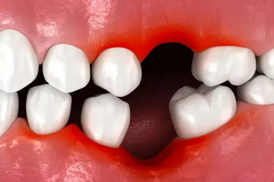 Jak wygląda suchy zębodół i kiedy iść do dentysty?