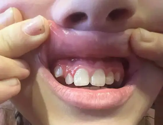 Ząb wyrasta bokiem z dziąsła? Co to znaczy i kiedy iść do dentysty