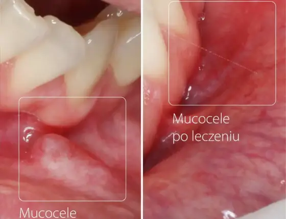 Torbiel na policzku - kiedy to ropień, a kiedy mukocele?