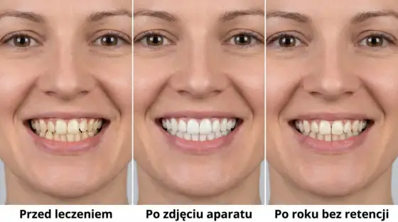 Aparat ortodontyczny - efekty, czas leczenia i retencja
