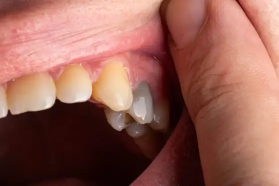 Martwica dziąsła - objawy, leczenie i kiedy do dentysty