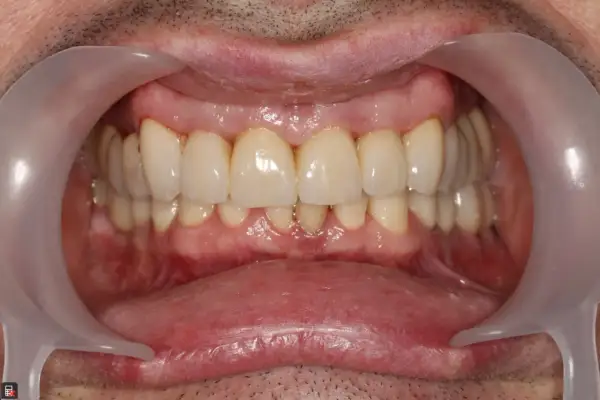 Uśmiech po leczeniu. Zdrowe dziąsła i zęby, to cel periodontologii. Co to jest? To dziedzina stomatologii zajmująca się leczeniem chorób przyzębia.