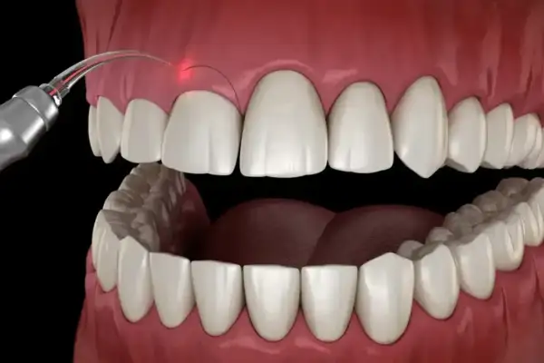 Zabieg gingiwektomii laserem. Precyzyjne cięcie dziąseł w celu poprawy estetyki uśmiechu.
