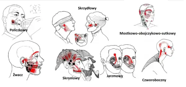 Ilustracje pokazują punkty bólu związane z urazem szczęki po uderzeniu w różne obszary twarzy i szyi.