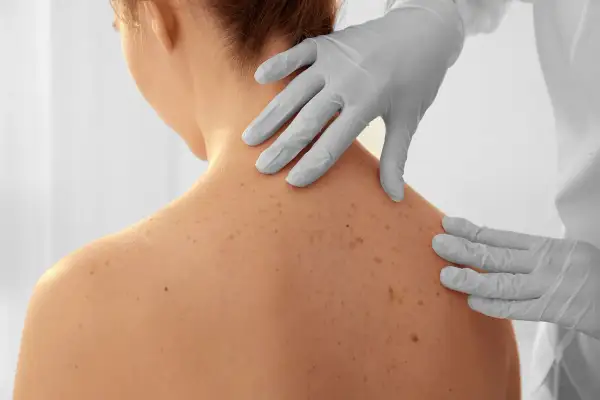 Dermatolog w rękawiczkach bada pieprzyki na plecach pacjentki.