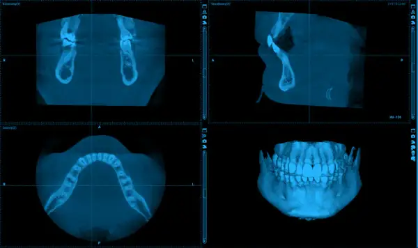 CBCT co to? Obraz przedstawia trójwymiarowe skanowanie szczęki i żuchwy, ukazujące zęby i kości w różnych przekrojach.