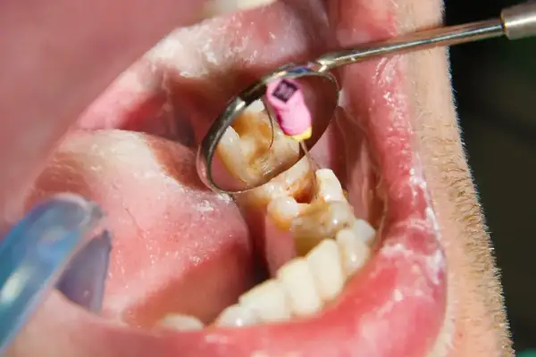 Widok jamy ustnej z widocznym narzędziem dentystycznym i zębem. Widać stan zapalny dziąsła, a w odbiciu lusterka fragment zęba z widoczną ropą.