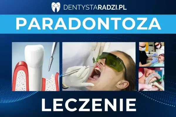 Leczenie paradontozy: ilustracja zęba z ubytkami kostnymi, zabieg laserowy i stomatologiczne procedury.