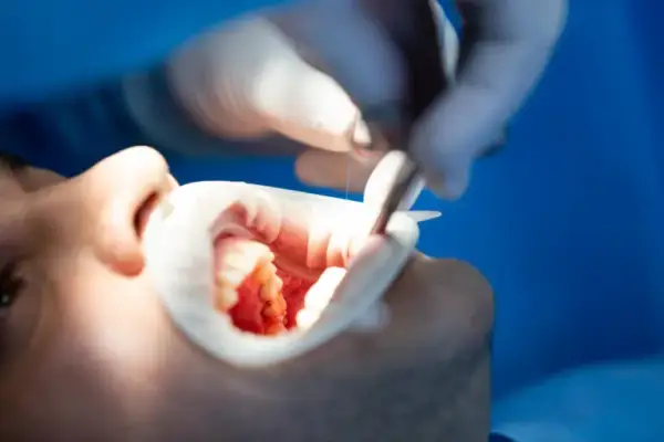 Co dentysta robi z wyrwanym zębem? Ważne informacje i procedury