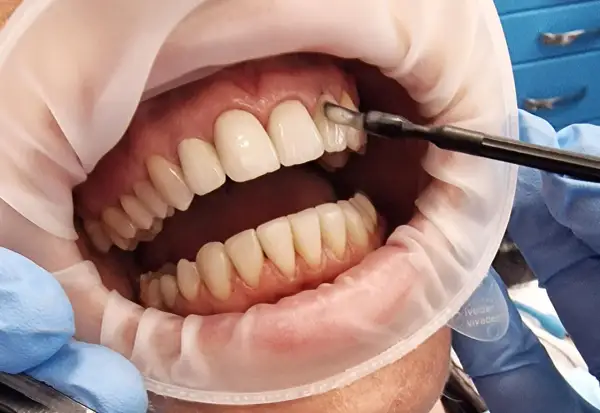 Zabieg lakierowania zębów w gabinecie stomatologicznym. Dentysta aplikuje preparat na zęby.