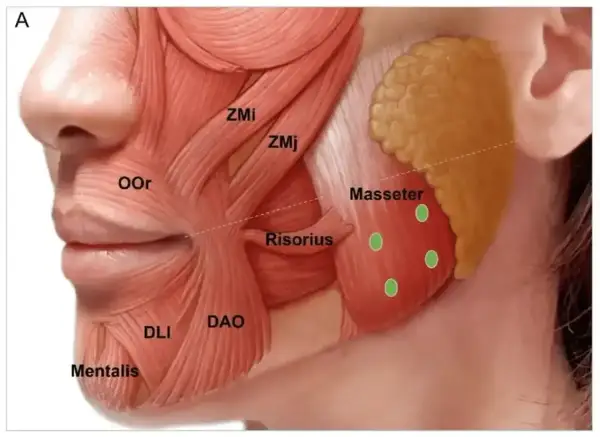 Anatomia mięśnia żwacza, z zaznaczonymi punktami iniekcji botoksu. Pomocne w leczeniu bruksizmu.